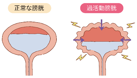 過活動膀胱_1