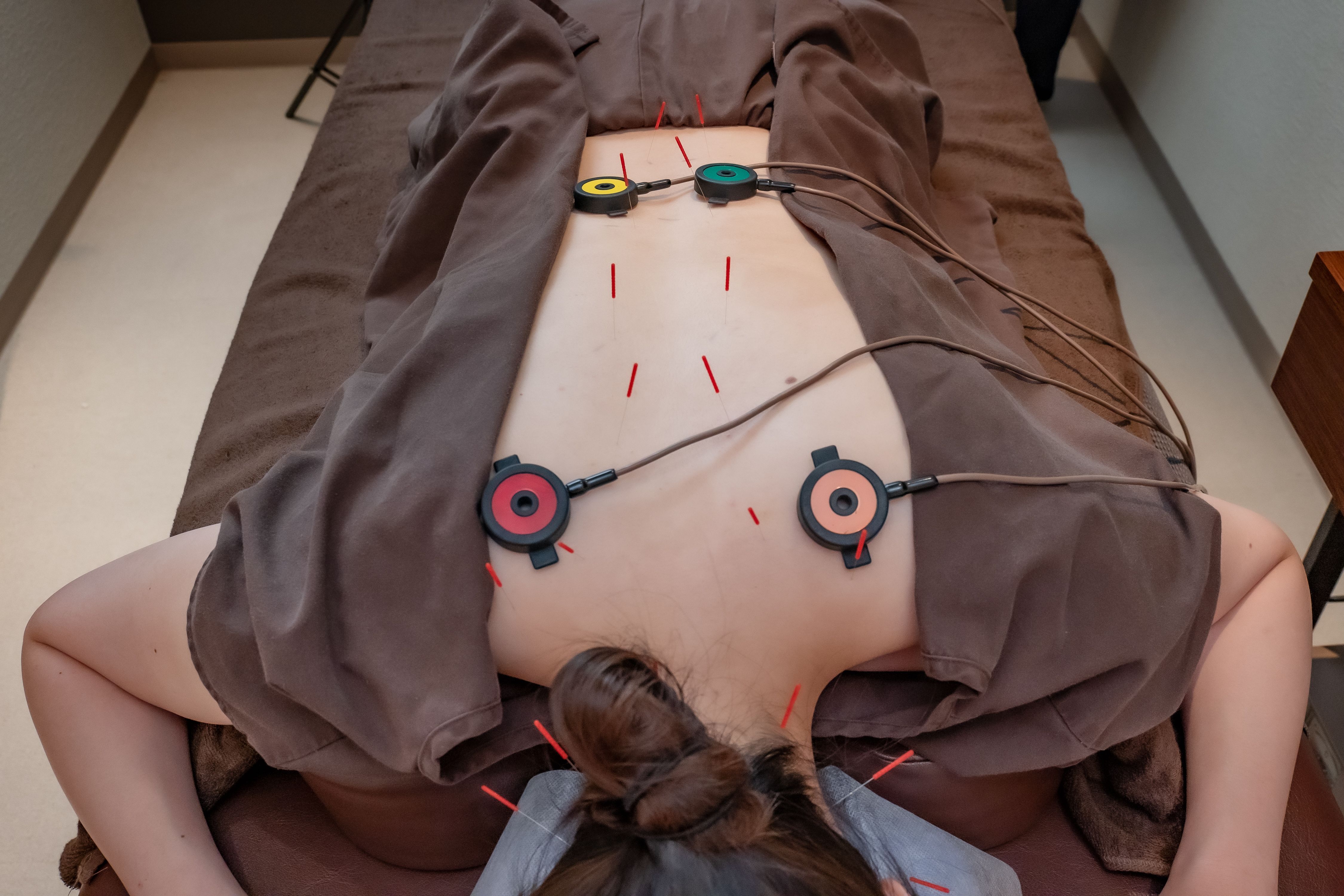 背中の鍼+温灸器_1