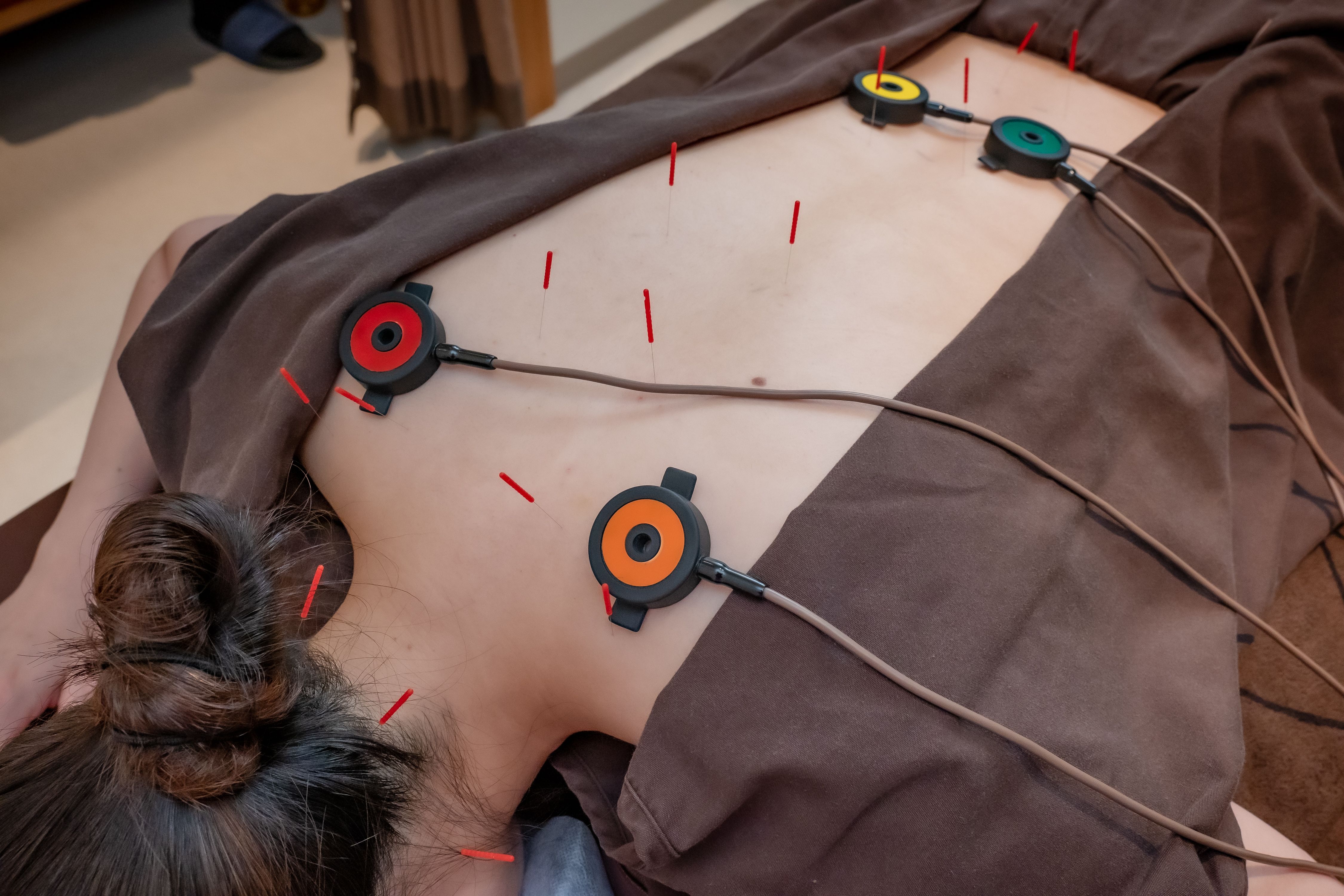 背中の鍼と温灸器